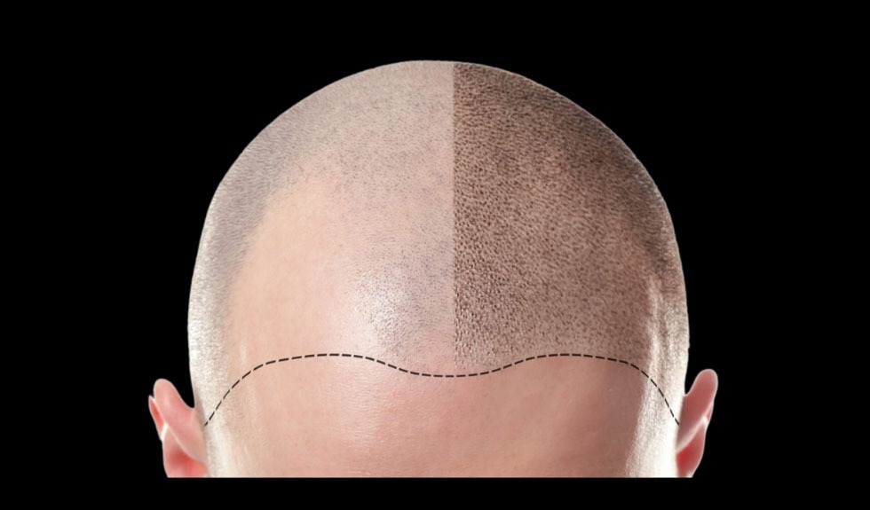 Why You Should Add Scalp Micropigmentation to Your Treatment Menu?