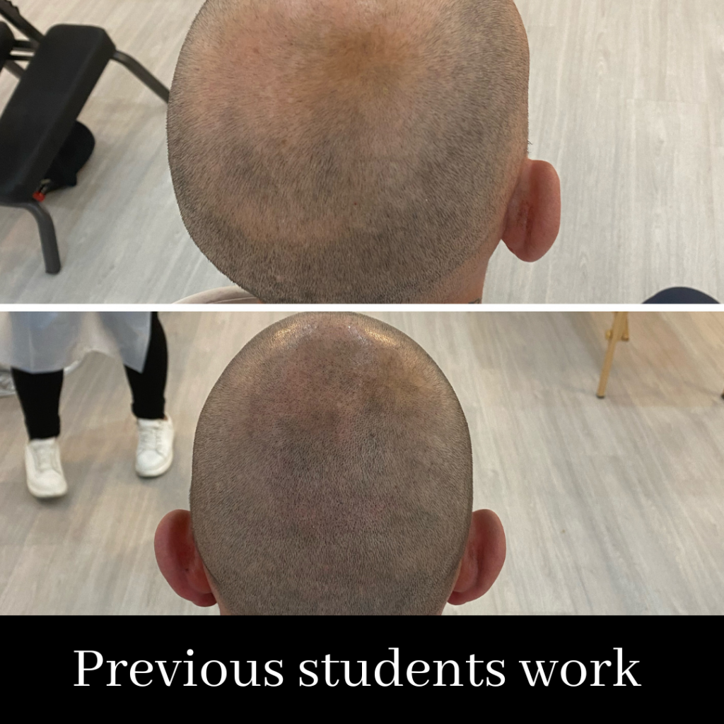 Scalp Micropigmentation Course. SALE PRICE- £1999 normally £2999 (including FULL kit)
