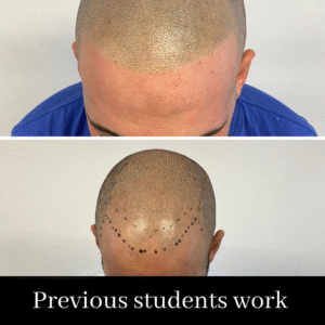 Scalp Micropigmentation Course. SALE PRICE- £1999 normally £2999 (including FULL kit)
