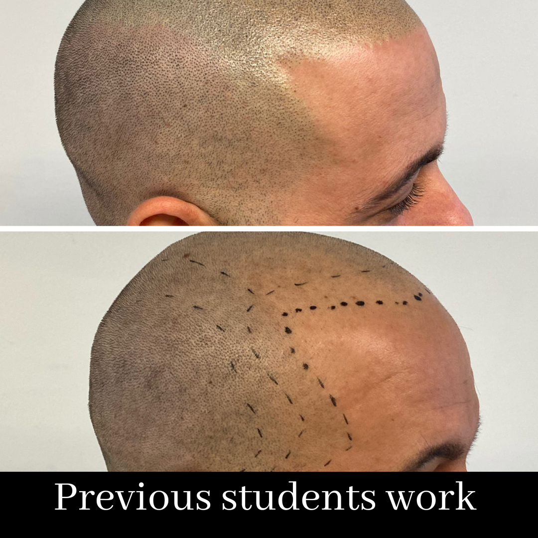 Scalp Micropigmentation Course. SALE PRICE- £1999 normally £2999 (including FULL kit)