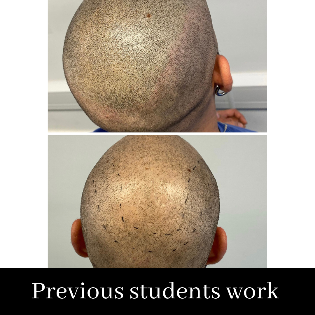 Scalp Micropigmentation Course. SALE PRICE- £1999 normally £2999 (including FULL kit)