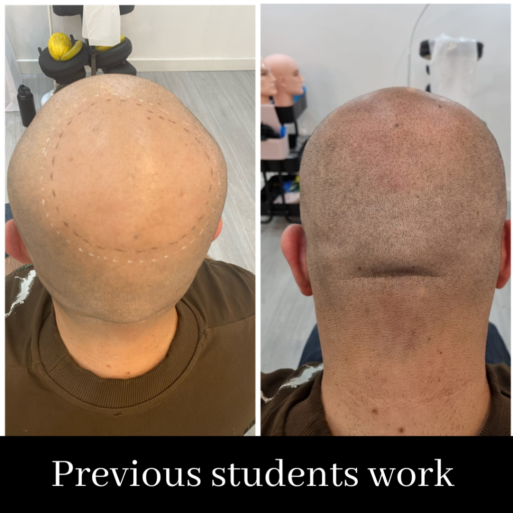 Scalp Micropigmentation Course. SALE PRICE- £1999 normally £2999 (including FULL kit)