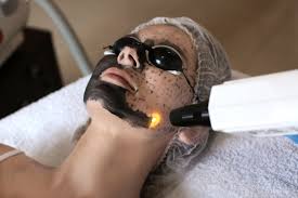 5 Powerful Benefits of a Carbon Laser Facial