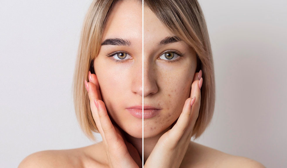 enrolling in skin boosters course