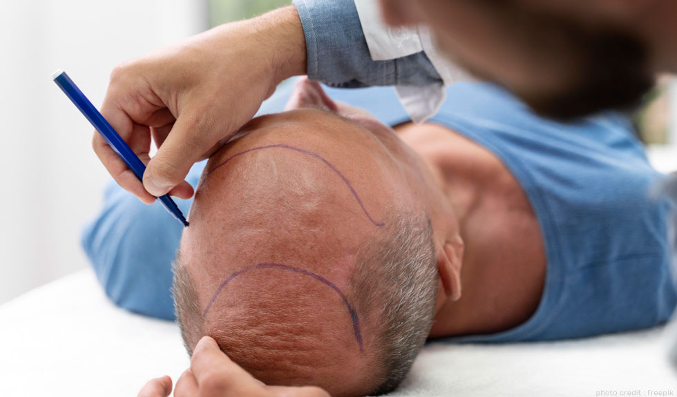 scottish beauty expert scalp micropigmentation course