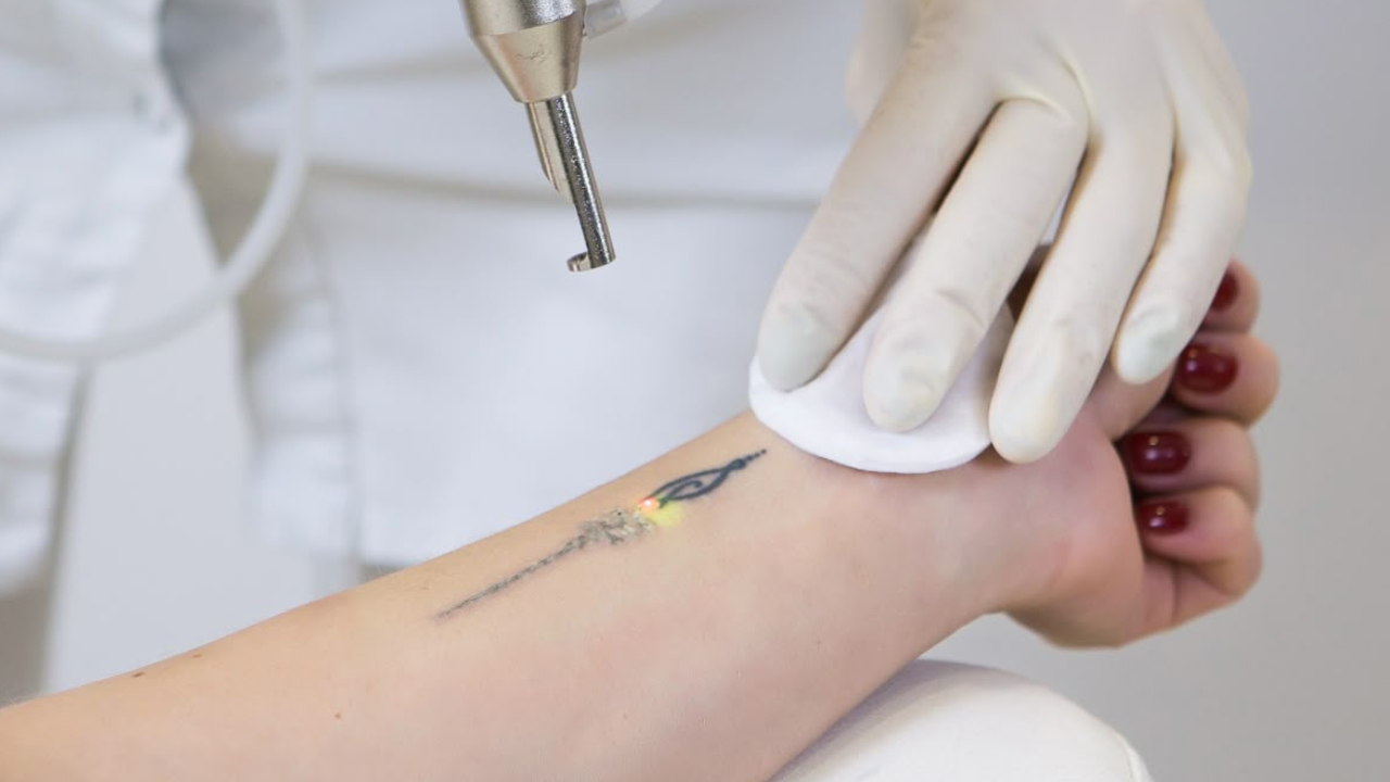 Laser tattoo removal treatment session on a client